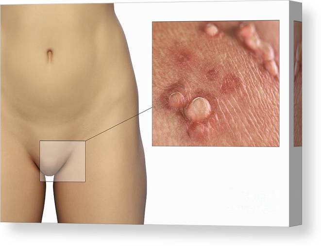 زگیل تناسلی