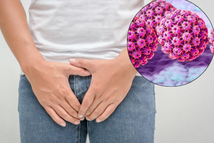 زگیل تناسلی