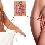 زگیل تناسلی