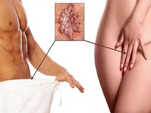 زگیل تناسلی