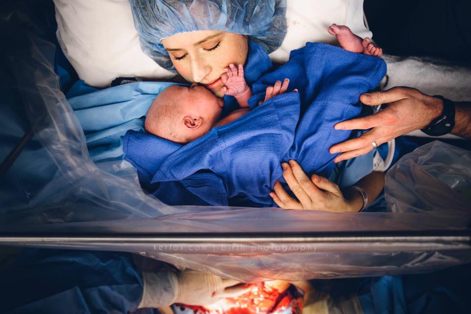 زایمان سزارین