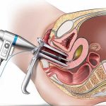 هیستروسکوپی - دكتر بيتا زلالي