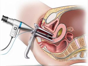 هیستروسکوپی - دكتر بيتا زلالي