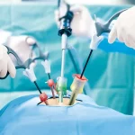 لاپاراسکوپی چیست و چگونه انجام می شود؟