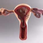 کیست تخمدان