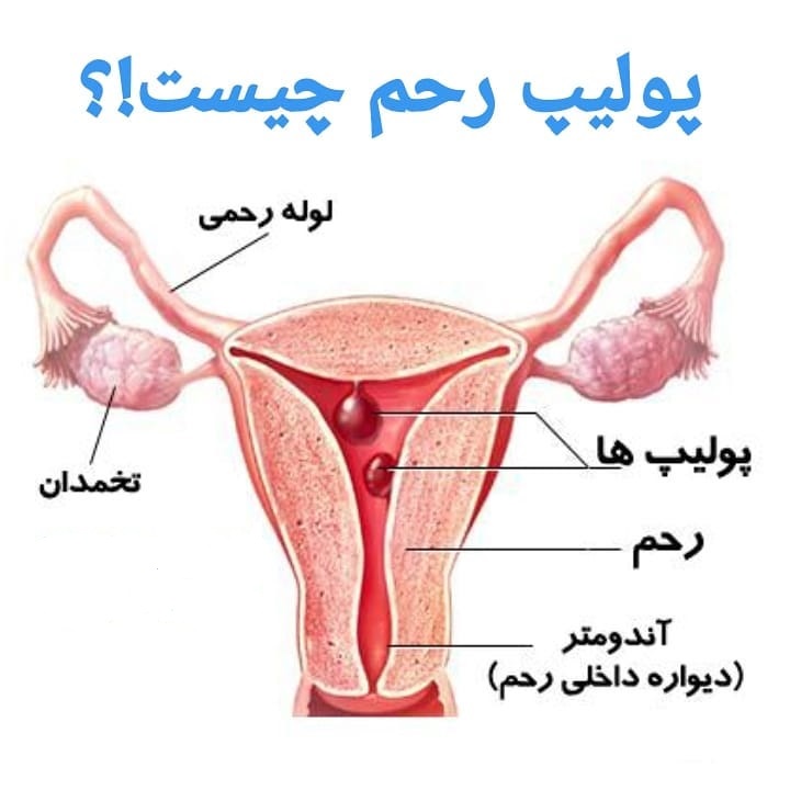 پولیپ رحم