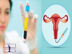 PRP تخمدان - پی آر پی تخمدان - دکتر بیت زلالی