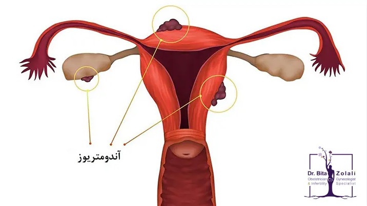 خراش آندومتر با هیستروسکوپ قبل از آی وی اف – دکتر بیتا زلالی خراش آندومتر با هیستروسکوپ قبل از آی وی اف - دکتر بیتا زلالی