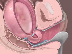 سرکلاژ شکمی
