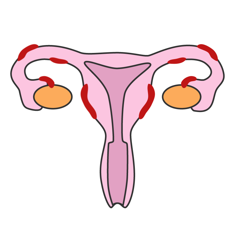 بیماری آندومتریوز در زنان
