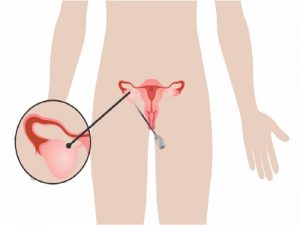 لاراسکوپی کیست تخمدان