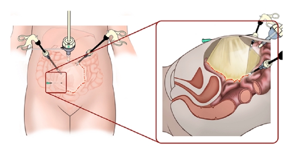روش انجام لاپاراسکوپی کیست تخمدان