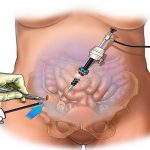 لاپاراسکوپی کیست تخمدان