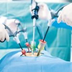 لاپاراسکوپی آندومتریوز - دکتر بیتا زلالی