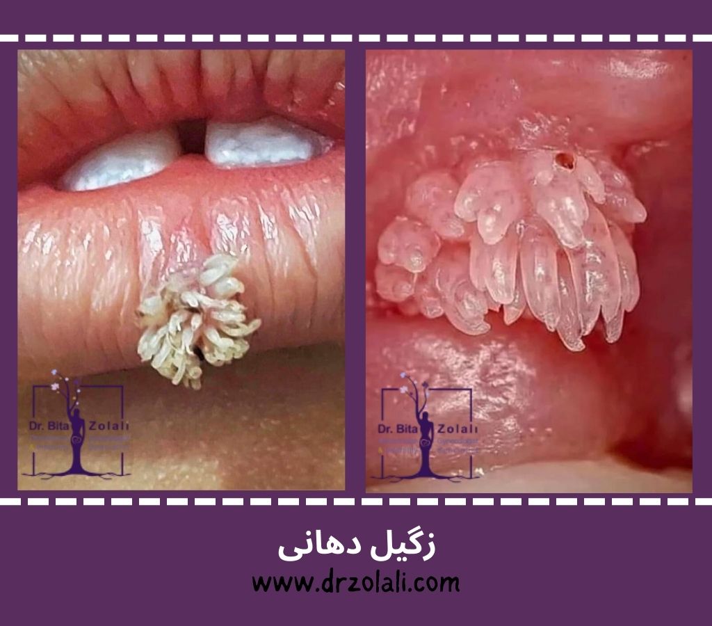 تصویر زگیل دهان و زگیل دهانی خفیف - دکتر بیتا زلالی