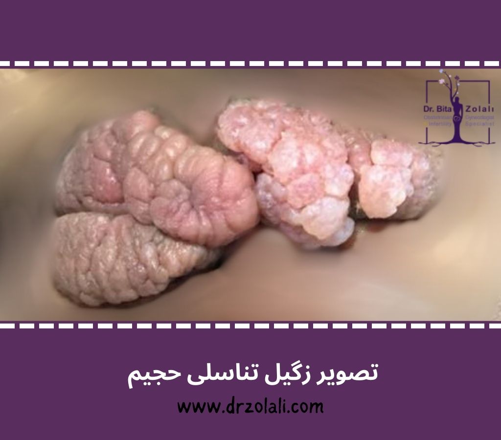 عکس زگیل تناسلی - دکتر بیتا زلالی