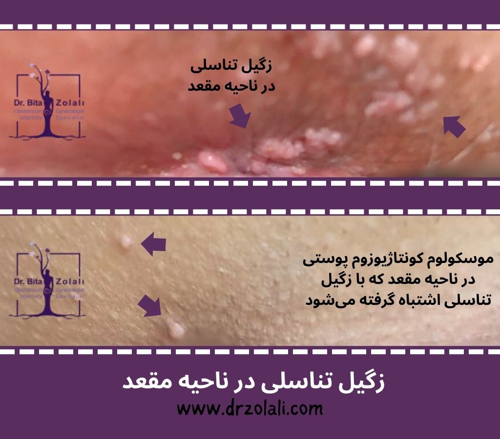 عکس زگیل مقعد و موسکولوم کونتاژیوزوم پوستی - دکتر زلالی