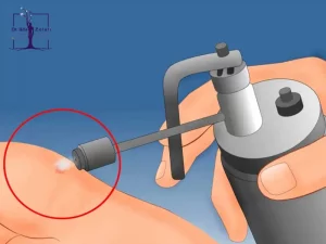 درمان زگیل تناسلی با کرایوتراپی