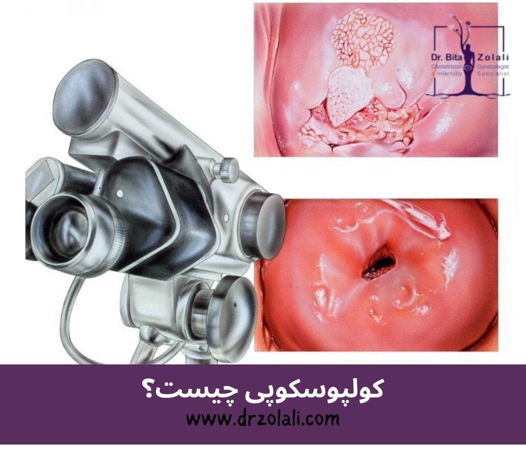 کولپوسکوپی چیست؟ – دکتر بیتا زلالی آیا انجام کولپوسکوپی درد و خون ریزی دارد؟ - دکتر بیتا زلالی