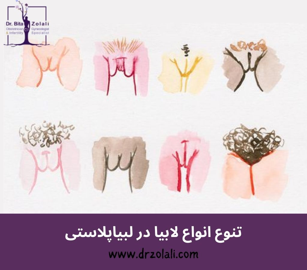 شکل های مختلف لابیا در لابیاپلاستی بدون بخیه – دکتر زلالی شکل های مختلف لابیا در لابیاپلاستی بدون بخیه - دکتر زلالی