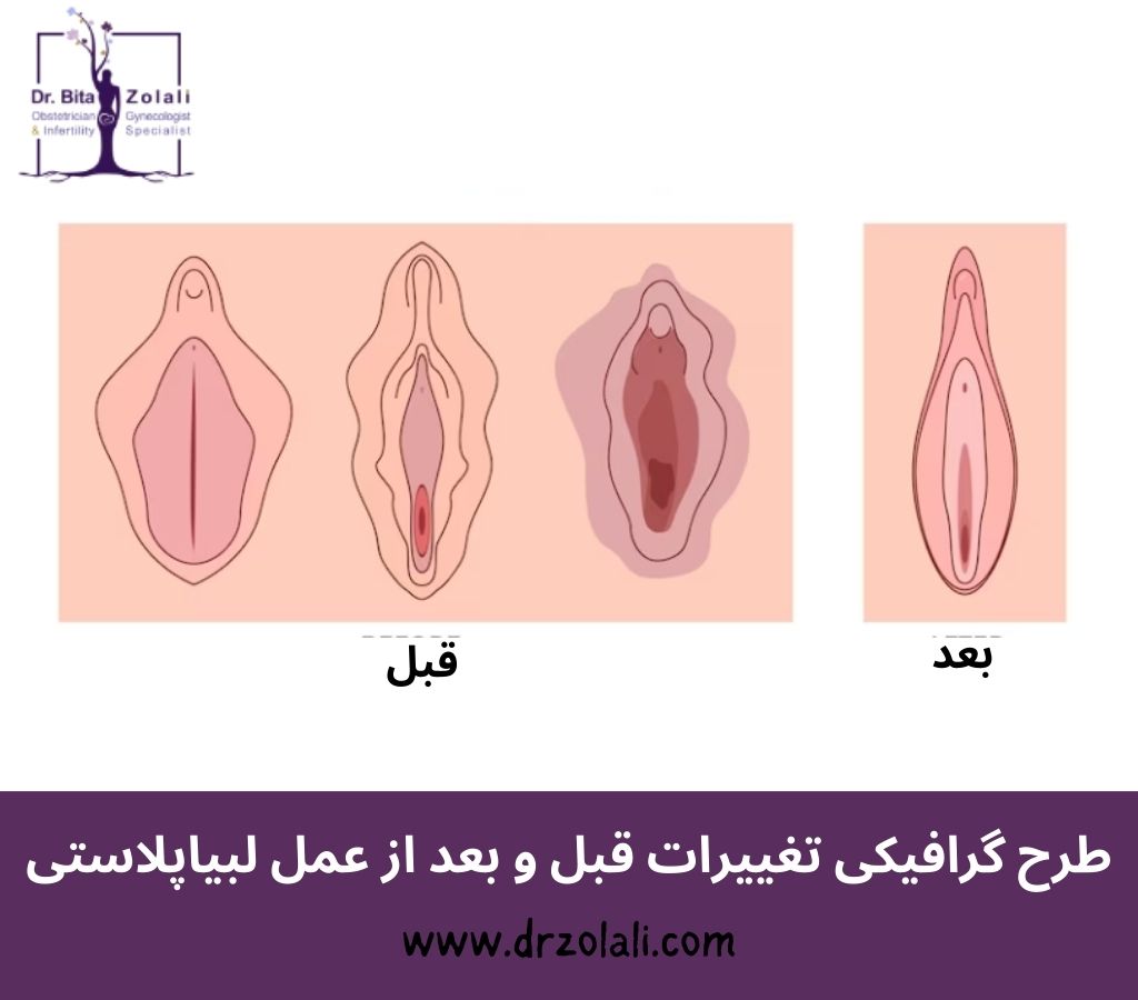 عکس قبل و بعد لابیاپلاستی بدون بخیه – دکتر بیتا زلالی عکس قبل و بعد لابیاپلاستی بدون بخیه - دکتر بیتا زلالی