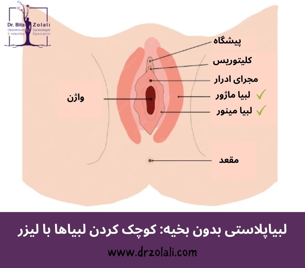 لبیای مینور و ماژور در لبیاپلاستی بدون بخیه – دکتر زلالی لبیای مینور و ماژور در لبیاپلاستی بدون بخیه - دکتر زلالی