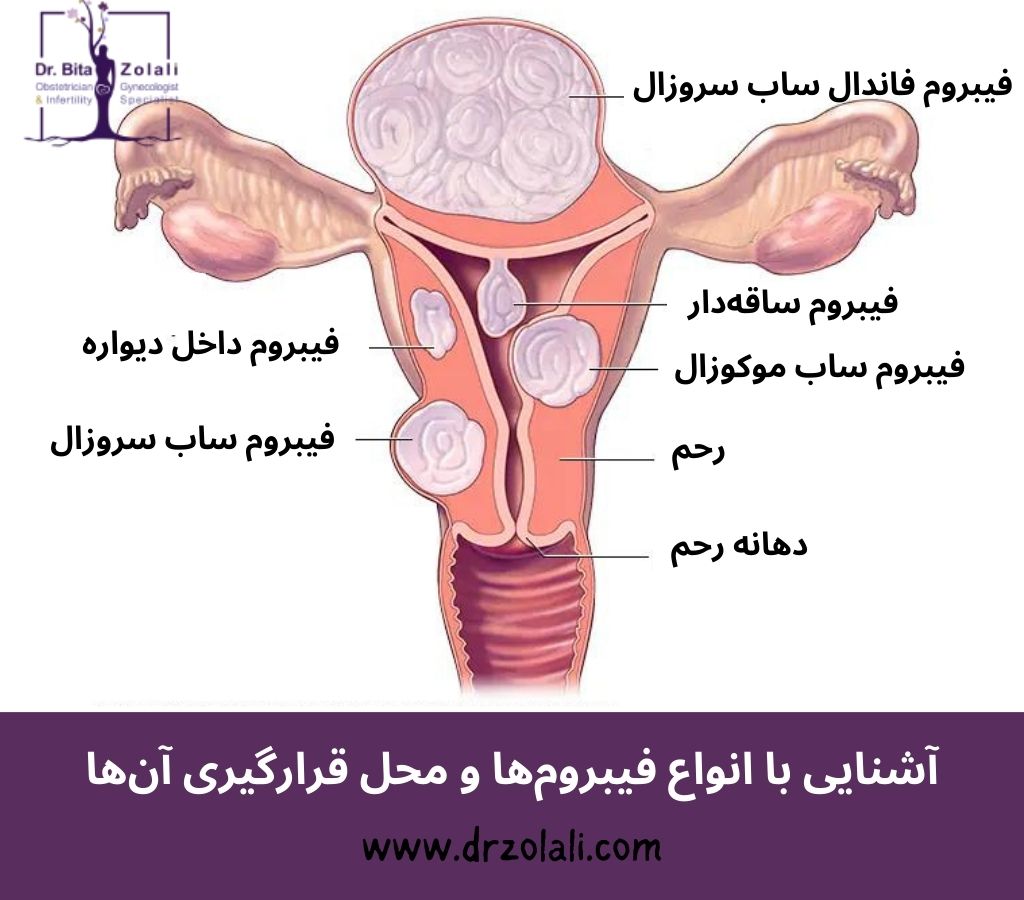 آشنایی با انواع فیبروم ها – دکتر بیتا زلالی آشنایی با انواع فیبروم ها - دکتر بیتا زلالی