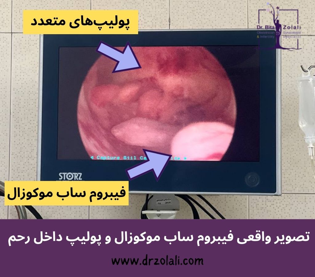 آیا فیبروم ساب موکوزال خطرناک است؟ – دکتر بیتا زلالی آیا فیبروم ساب موکوزال خطرناک است؟ - دکتر بیتا زلالی