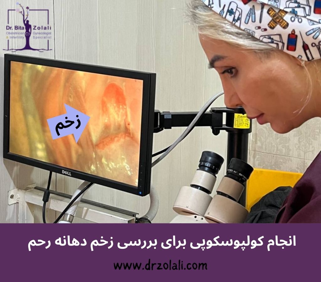 انجام کولپوسکوپی برای فریز زخم دهتنه رحم - دکتر زلالی