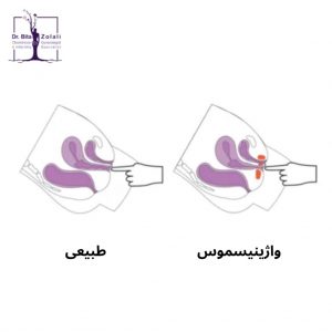 درمان واژینیسموس - دکتر بیتا زلالی