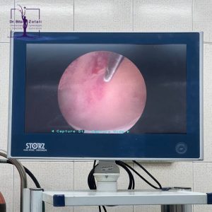 سپتوم رحمی - رحم سپتوم دار - رحم دیواره دار - دکتر بیتا زلالی