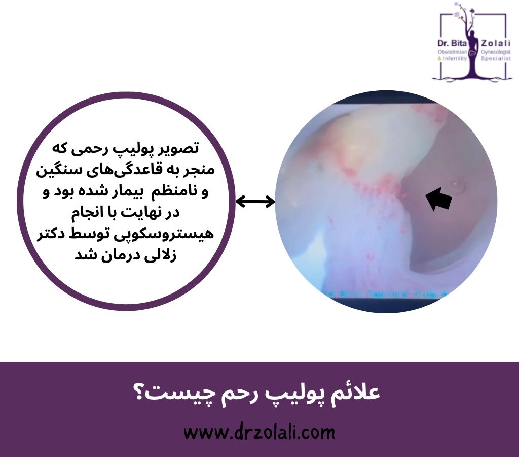 علائم پولیپ رحم – دکتر بیتا زلالی علائم پولیپ رحم - دکتر بیتا زلالی