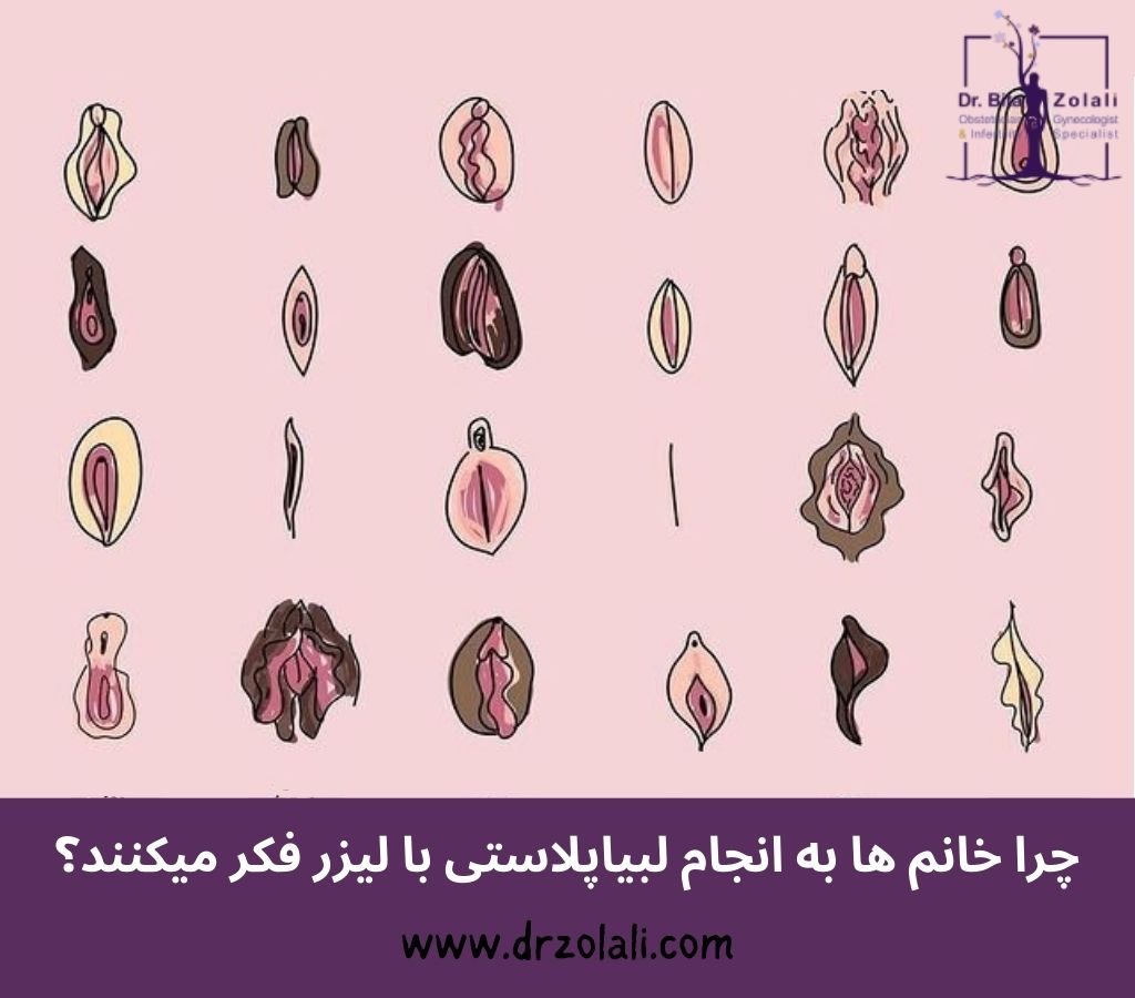 عمل لابیاپلاستی با لیزر – دکتر بیتا زلالی عمل لابیاپلاستی با لیزر - دکتر بیتا زلالی