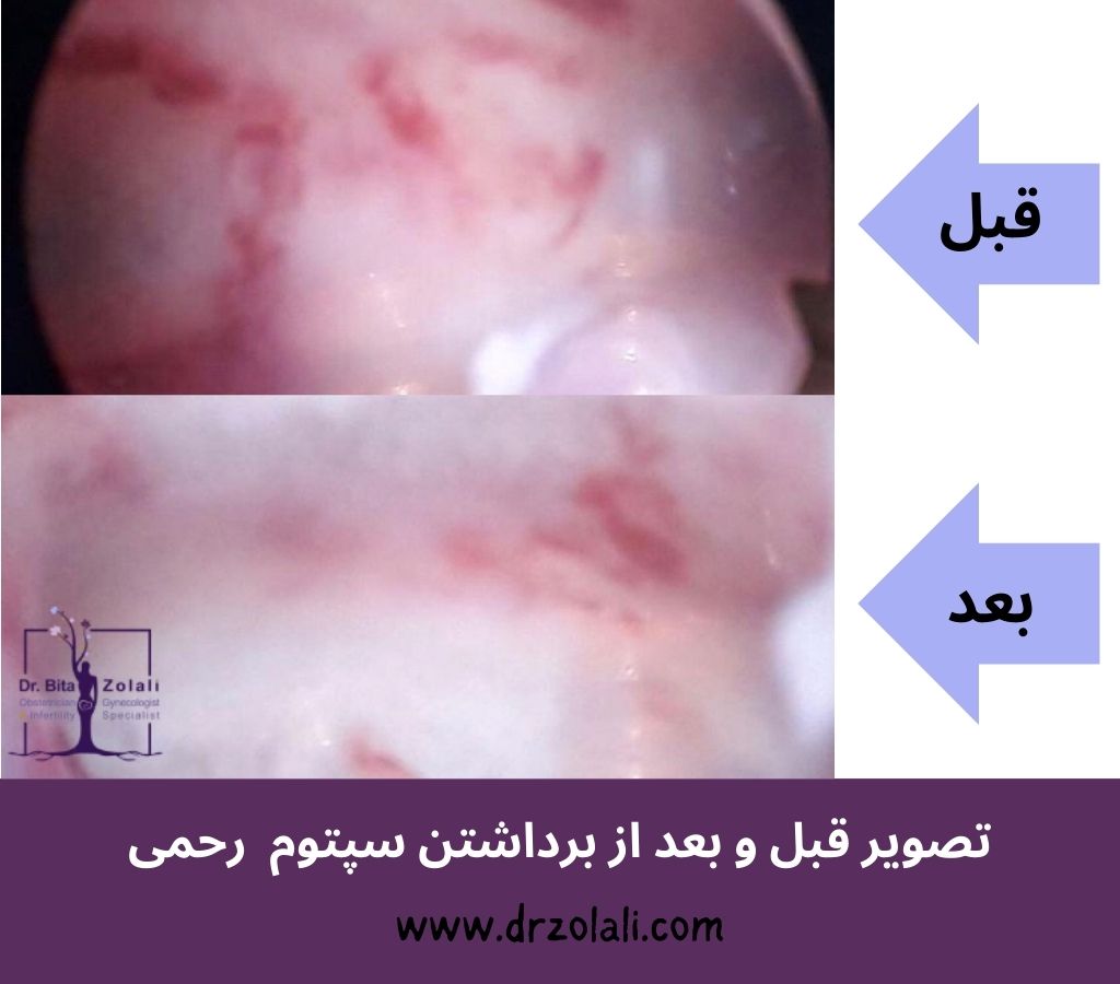 عکس قبل و بعد از برداشتن سپتوم رحمی - دکتر بیتا زلالی