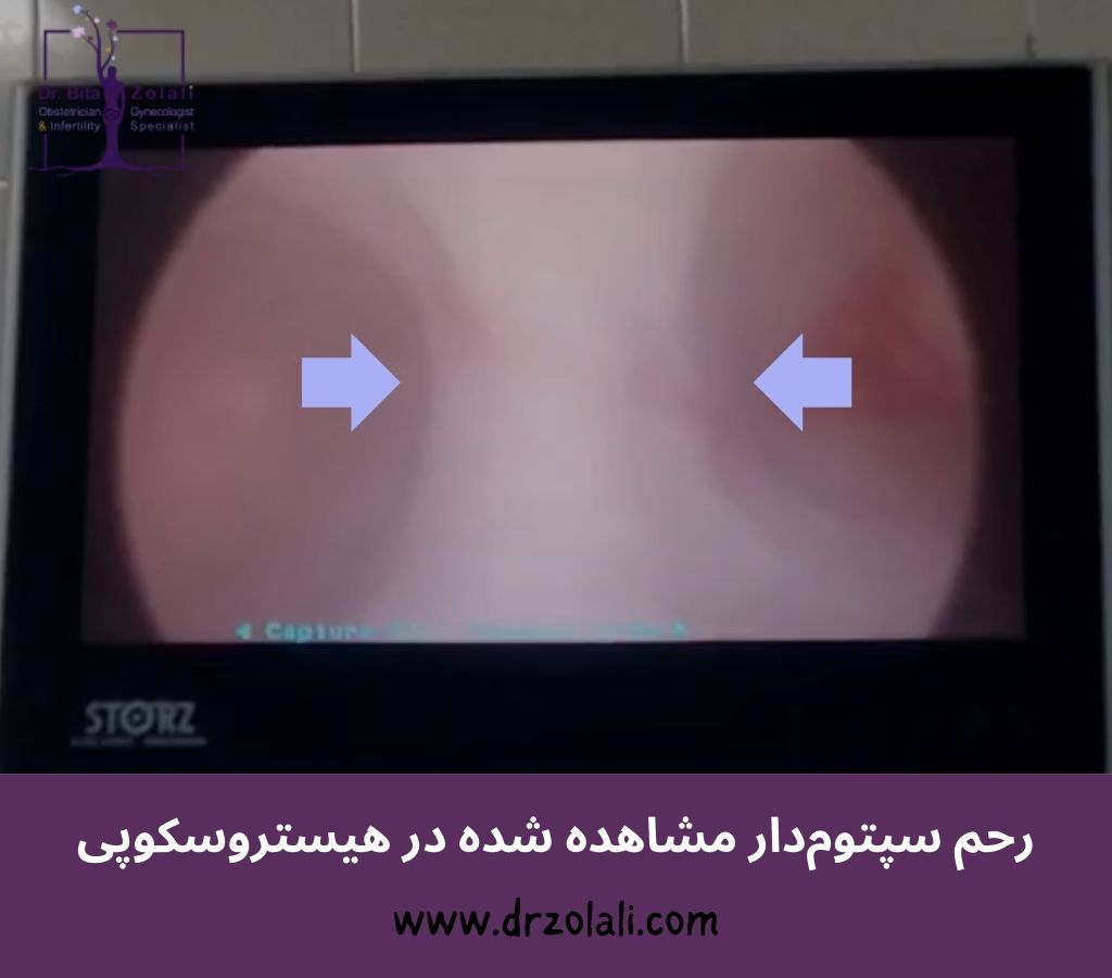 عکس واقعی سپتوم رحمی - دکتر بیتا زلالیعکس واقعی سپتوم رحمی - دکتر بیتا زلالی