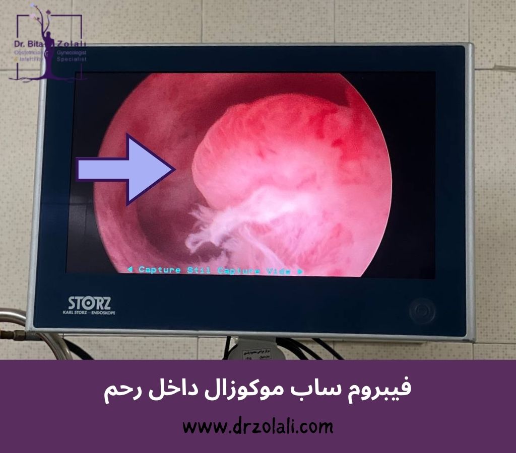 عکس واقعی فیبروم ساب موکوزال – دکتر بیتا زلالی عکس واقعی فیبروم ساب موکوزال - دکتر بیتا زلالی