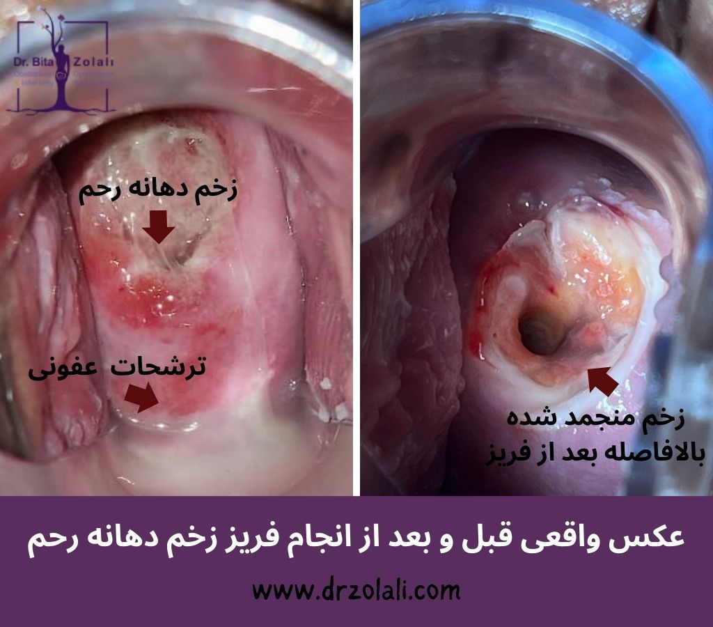 عکس واقعی قبل و بعد از فریز زخم دهانه رحم - دکتر زلالی