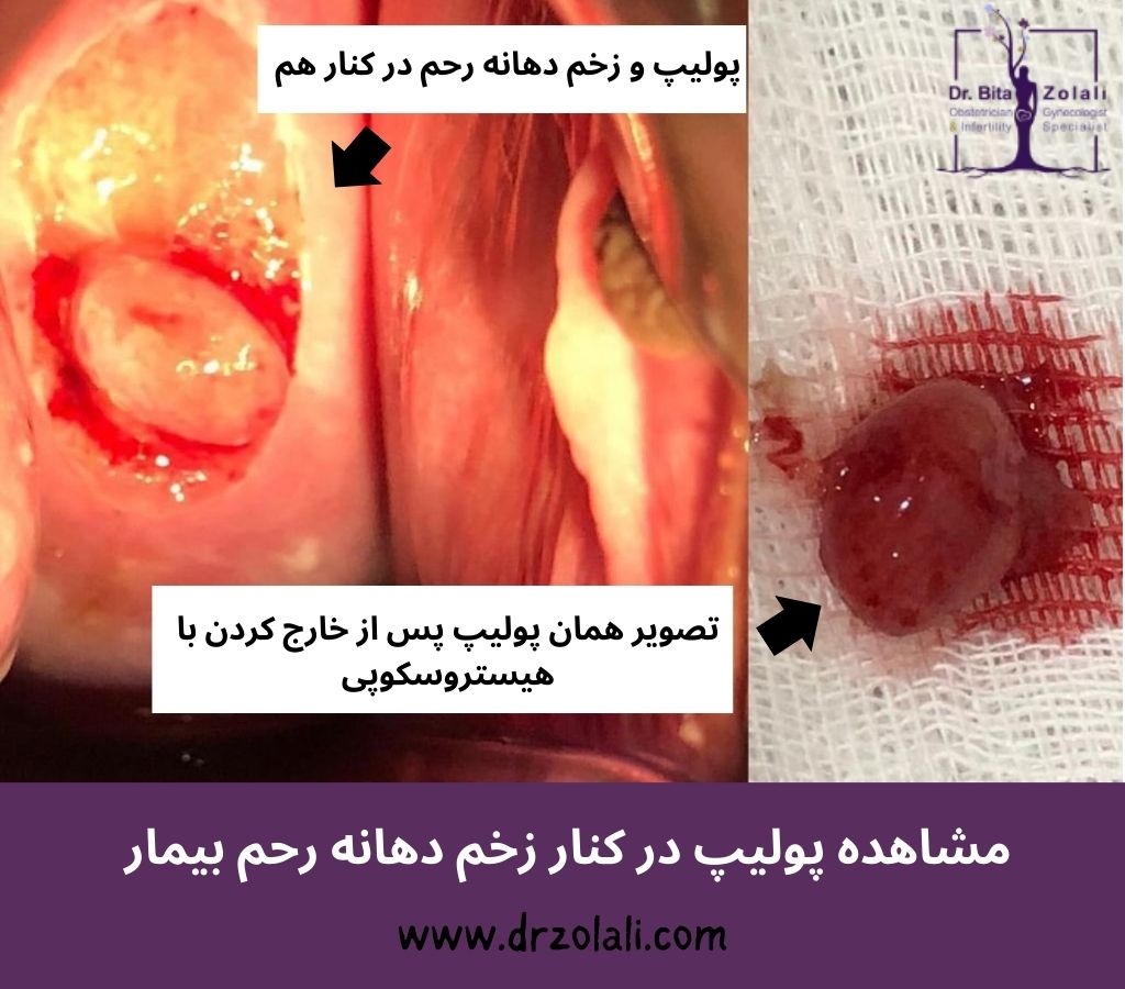 عکس پولیپ رحم – دکتر بیتا زلالی عکس پولیپ رحم - دکتر بیتا زلالی