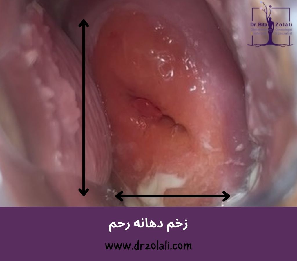فریز زخم دهانه رحم - دکتر بیتا زلالی