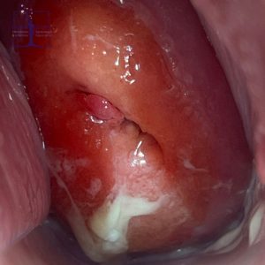 فریز زخم دهانه رحم یا کرایوتراپی - دکتر بیتا زلالی