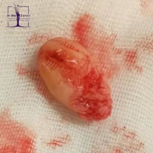 فیبروم ساب موکوزال - دکتر بیتا زلالی