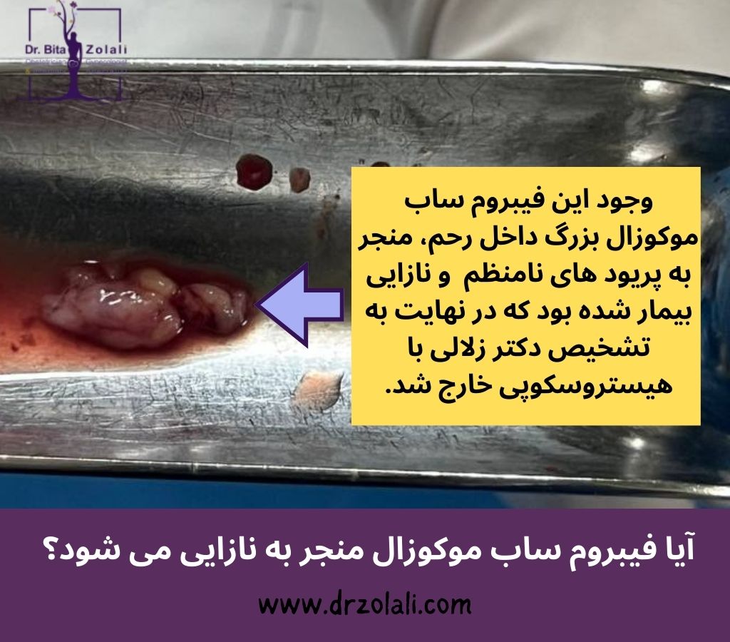 فیبروم ساب موکوزال و بارداری – دکتر بیتا زلالی فیبروم ساب موکوزال و بارداری - دکتر بیتا زلالی