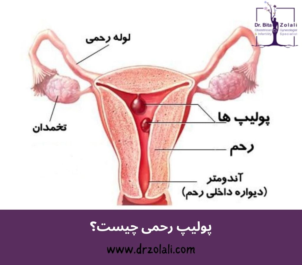 پولیپ رحم چیست؟ – دکتر بیتا زلالی پولیپ رحم چیست؟ - دکتر بیتا زلالی