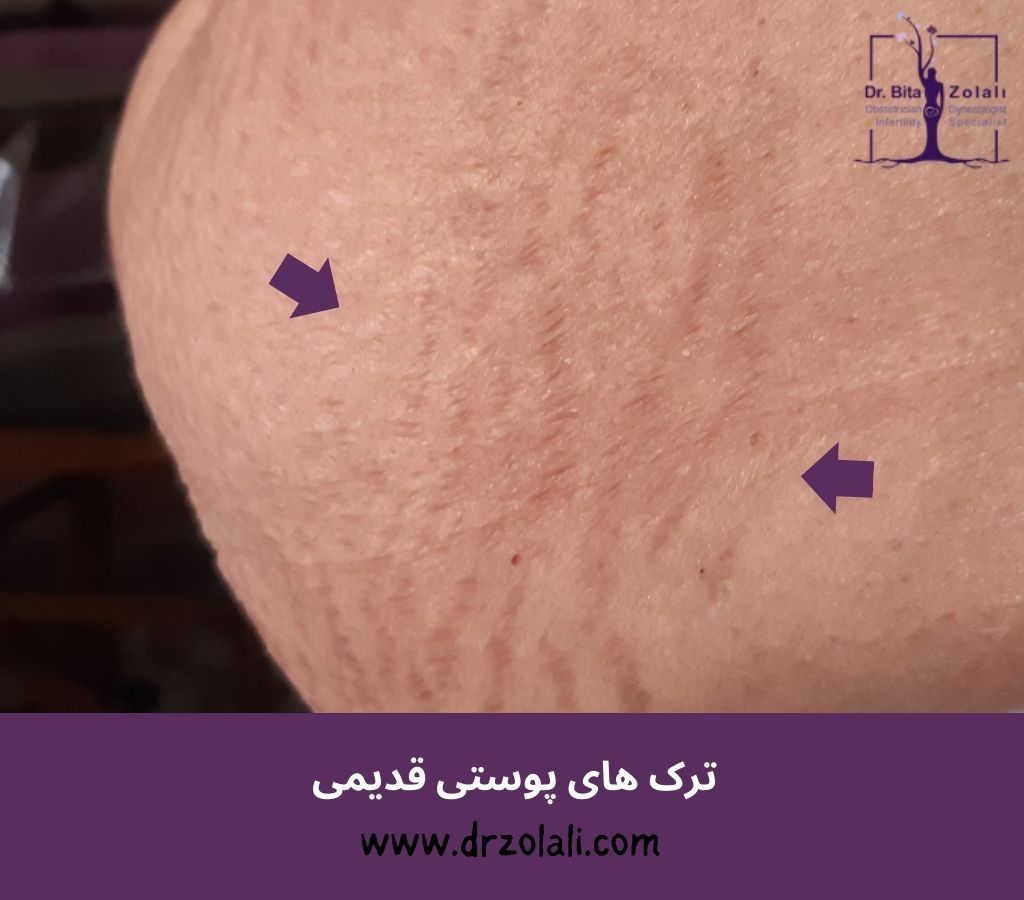 بهترین دستگاه درمان ترک های پوستی با لیزر - دکتر زلالی