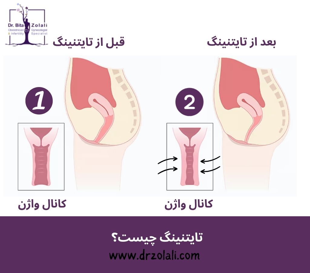 تایتنینگ چیست؟ – دکتر بیتا زلالی تایتنینگ چیست؟ - دکتر بیتا زلالی