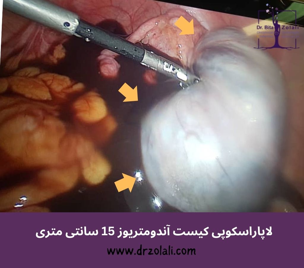 جراحی لاپاراسکوپی آندومتریوز – دکتر بیتا زلالی جراحی لاپاراسکوپی آندومتریوز - دکتر بیتا زلالی