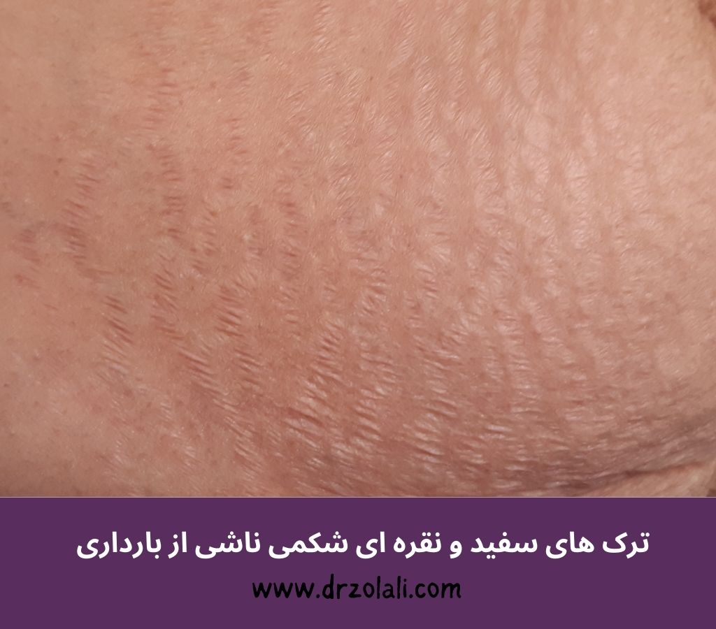 درمان ترک های پوستی بارداری یا لیزر - دکتر بیتا زلالی