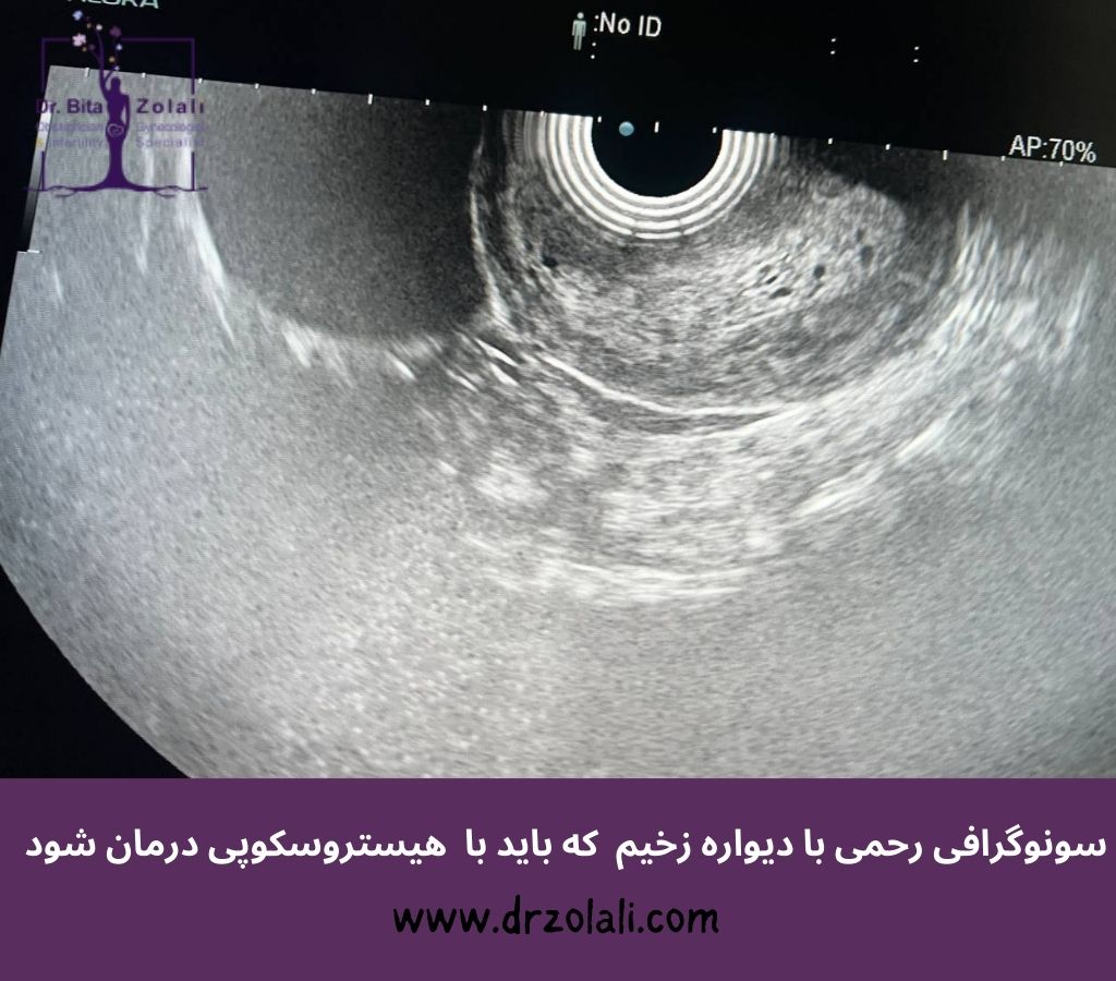 درمان زخیم شدن دیواره رحم با هیستروسکوپی رحم دکتر بیتا زلالی-