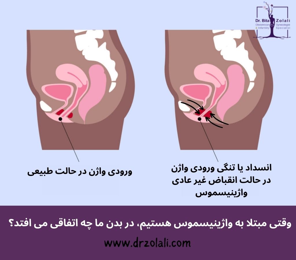 علائم واژینیسموس – دکتر بیتا زلالی علائم واژینیسموس - دکتر بیتا زلالی
