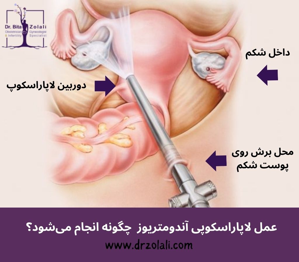 عمل لاپاراسکوپی آندومتریوز چطور انجام می شود – دکتر بیتا زلالی عمل لاپاراسکوپی آندومتریوز چطور انجام می شود - دکتر بیتا زلالی
